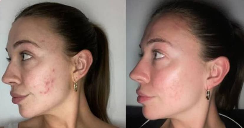 £11 Spot Cream Erases Acne Fast!