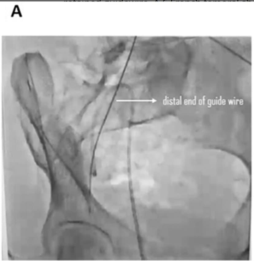Medical Wire Left Inside Woman for 3 Months