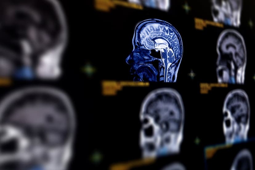 AI Predicts Alzheimer's With 93% Accuracy