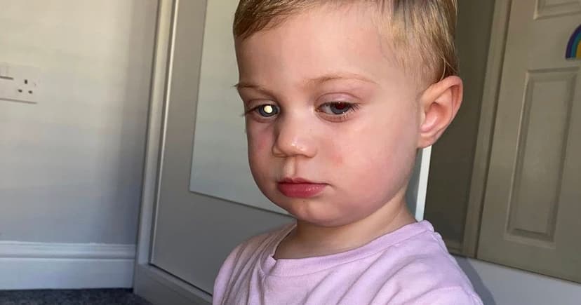 Baby's Eye Glow Reveals Rare Childhood Cancer