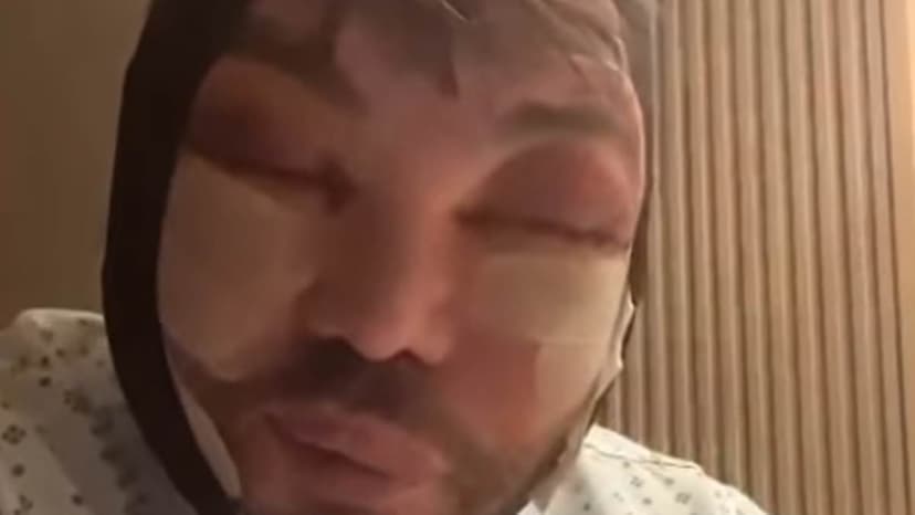 Bobby Norris struggles to sleep post-face and neck lift