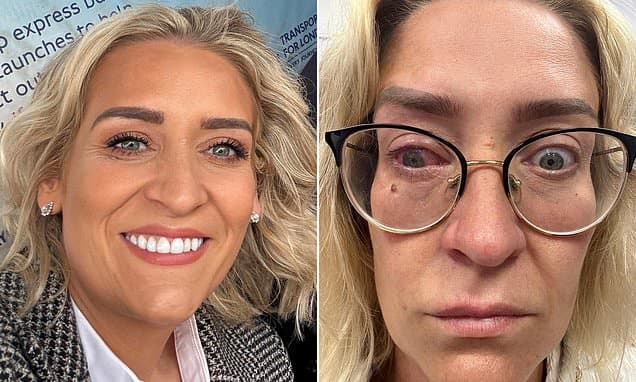 Contact Lens Horror: Woman Blinded in One Eye