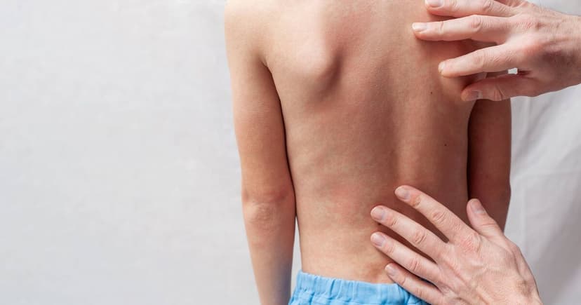 UK Faces Measles Surge, Urges Routine Childhood Vaccinations