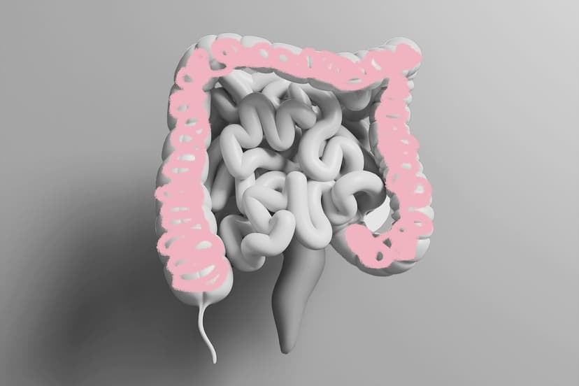 Colon Cancer Surges in Young Adults: Screening Age Lowered