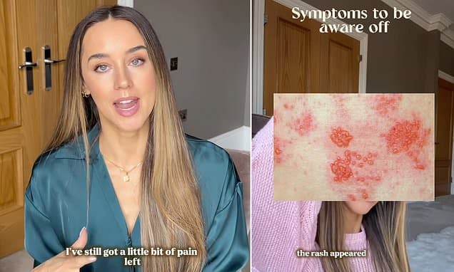 Emily Andre Reveals Shingles Secrets