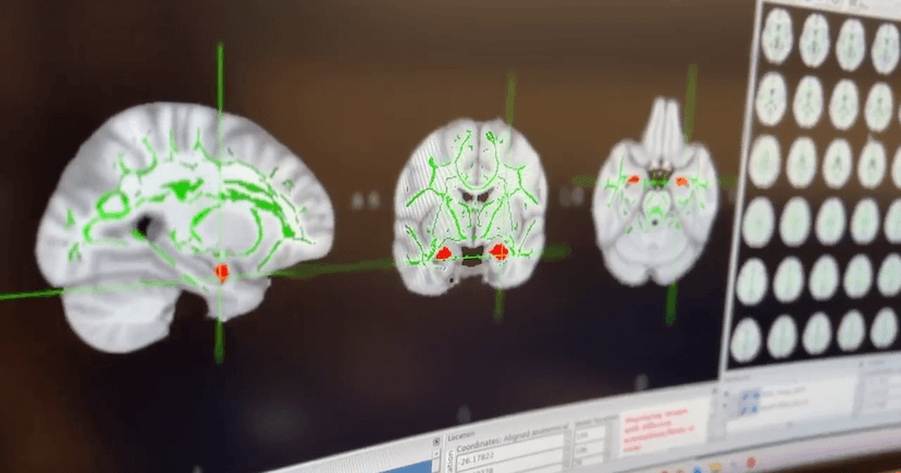 Racism's Toll: Emory Study Tracks Brain Impact