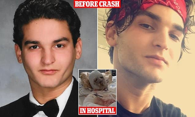 Man Survives 80% Burns, Gets New Face & Hands