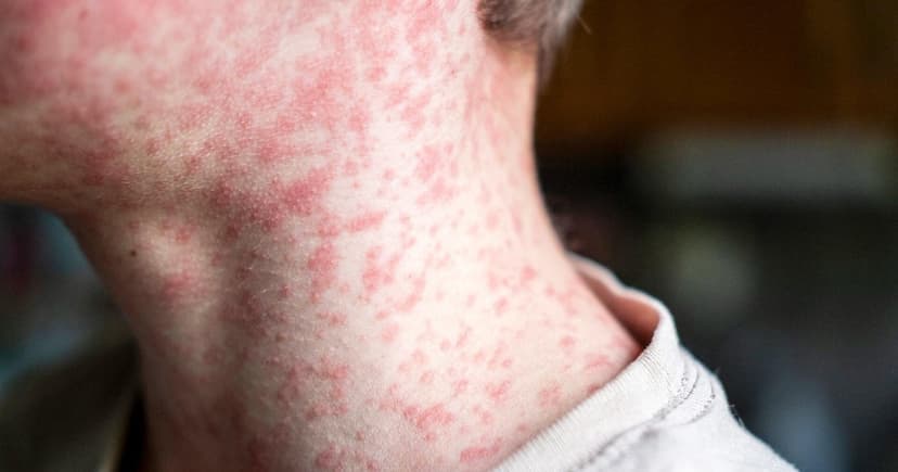 Measles Spreads: Riverside Confirms Case