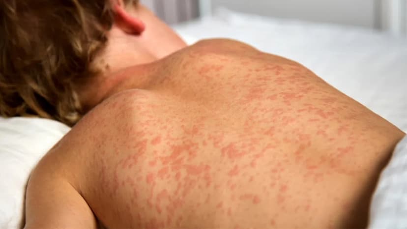 Manitoba Measles Alert: Public Exposed at Health Centers