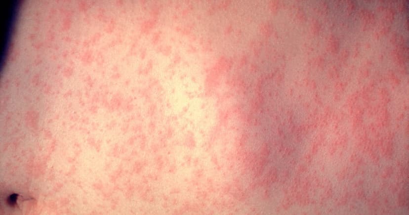 Measles Outbreak in Minnesota County