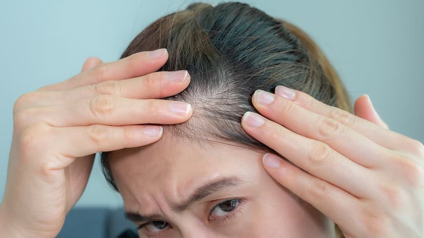 Menopause Triggers Hair Loss in Over Half of Women