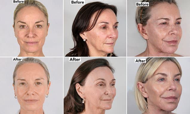 Stars Reveal Eternal Youth Secret: Non-Surgical Facelift