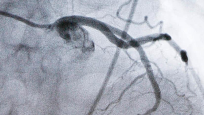 New Pill Beats Statins for Cholesterol