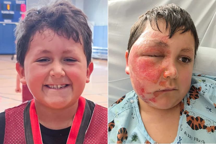 Toy Explodes, Injuring Boy in Viral Trend Gone Wrong