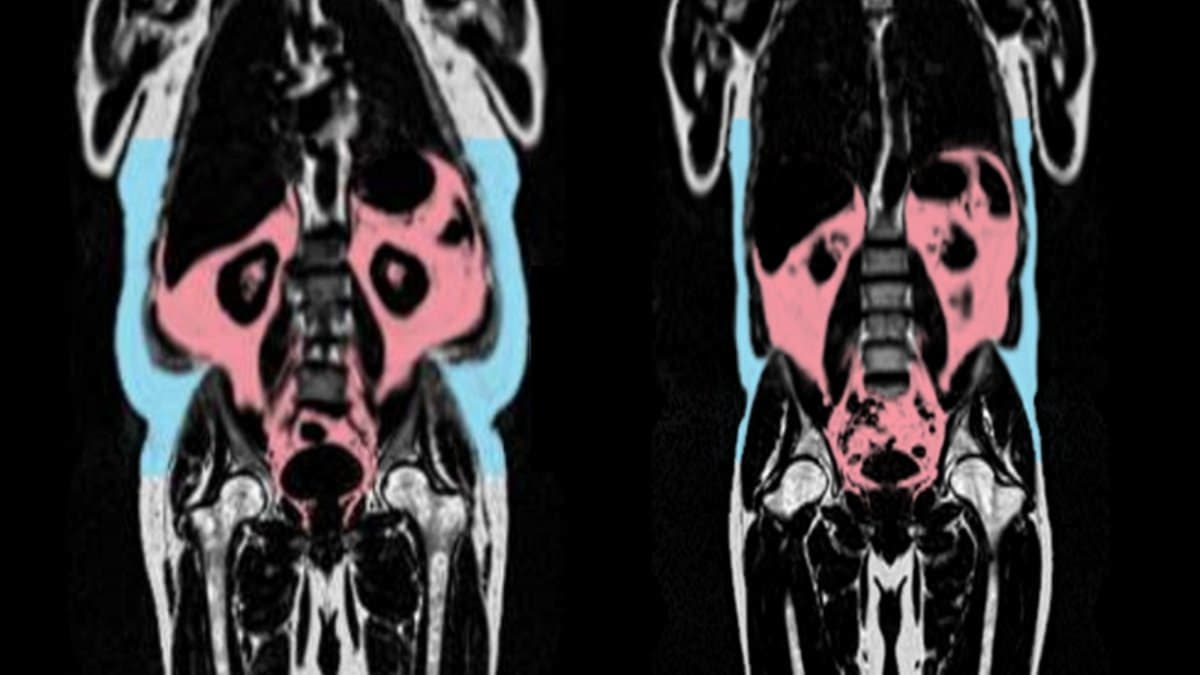 Slim People's Hearts May Age Faster Due to Hidden Fat