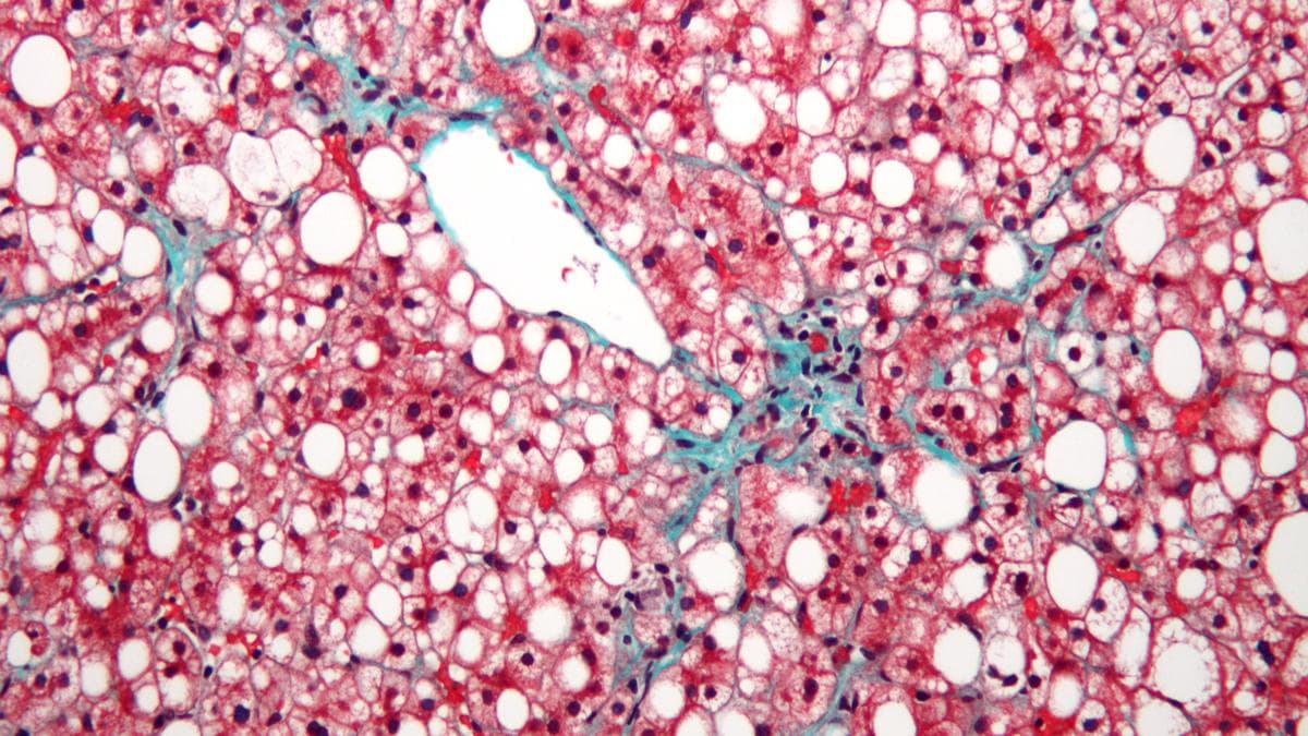 Fatty Liver Epidemic Sweeps India, Affecting 40-50 Crore People