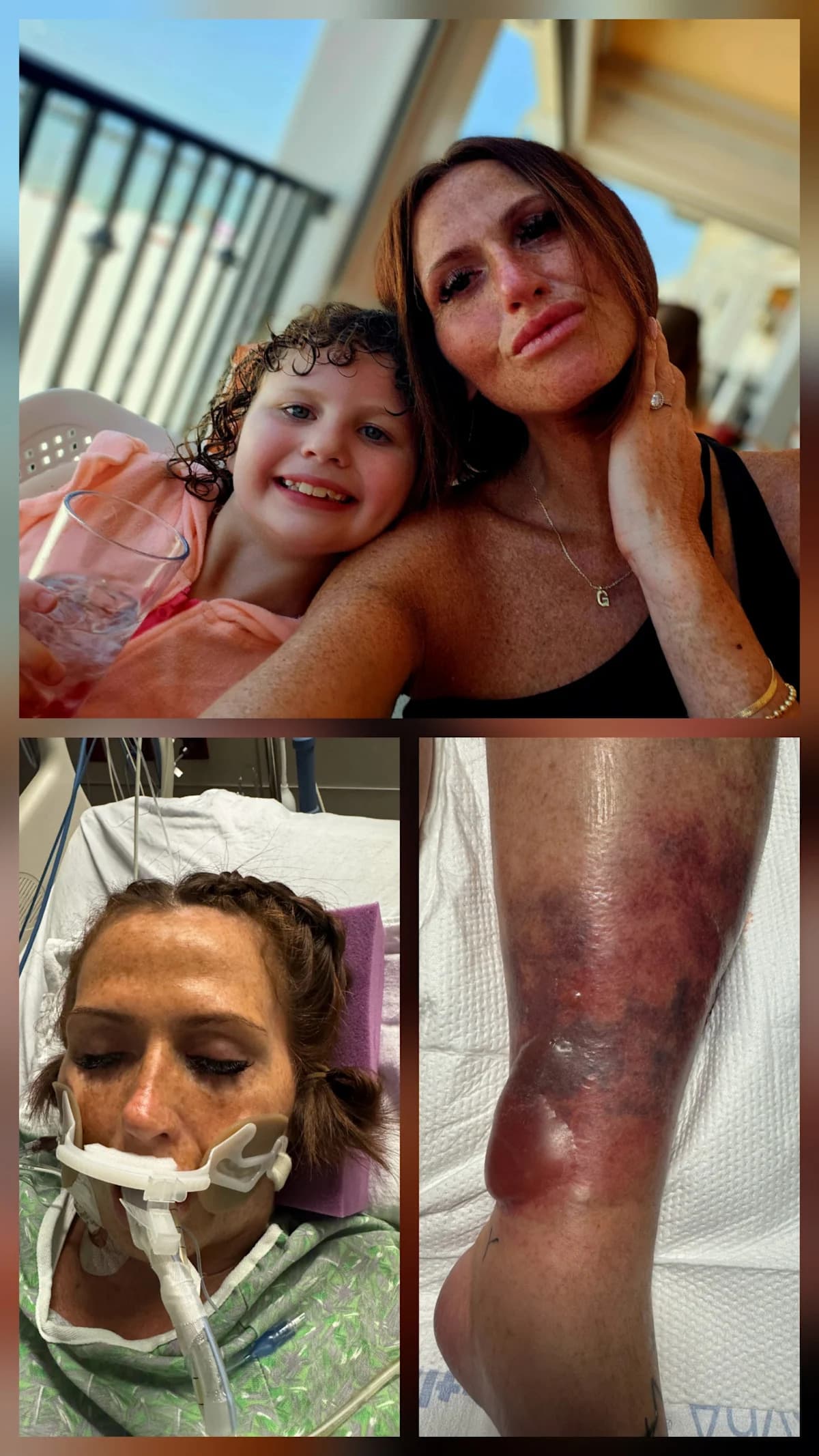 Woman Fights to Save Leg from Flesh-Eating Bacteria After Beach Swim
