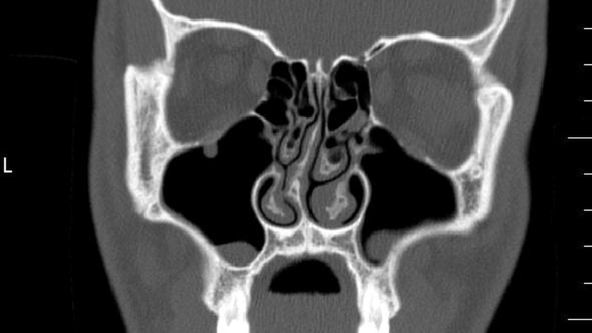 Deviated Septum: The Overlooked Nasal Obstruction Epidemic in India