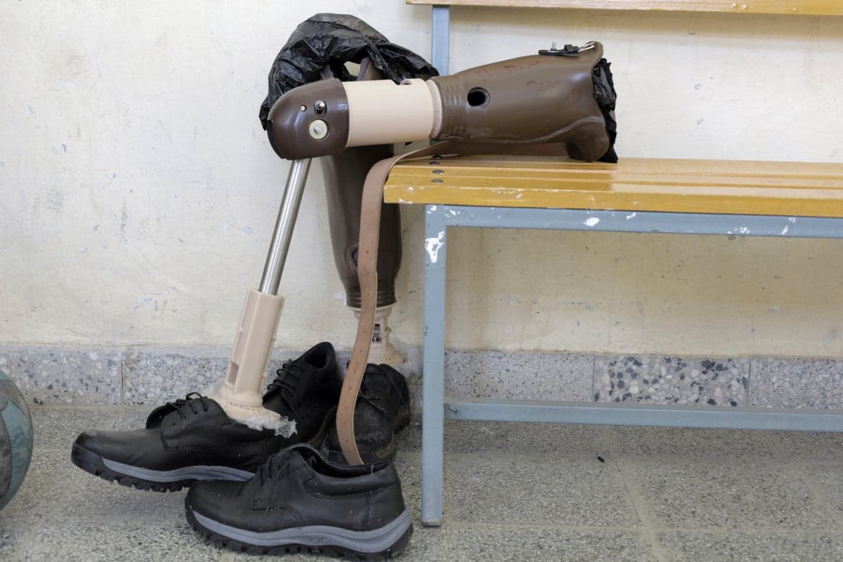 Amputated Limbs Remain Vividly Mapped in the Brain Years Later