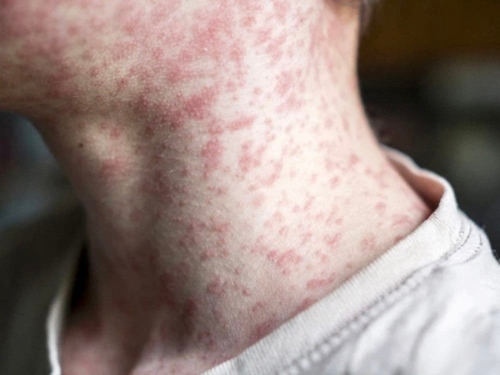Measles Outbreaks Highlight Erosion of Public Trust in Health Messaging