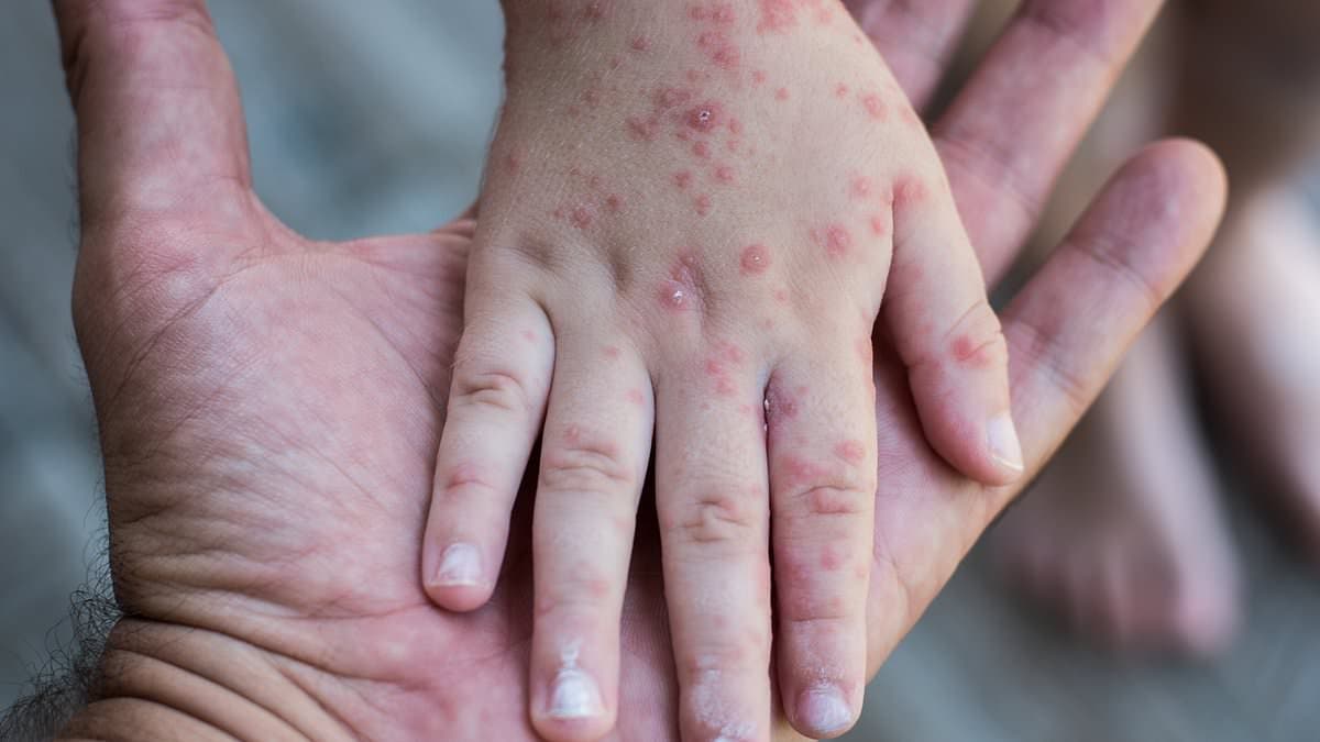 Pediatricians Warn of Nationwide Surge in Hand, Foot and Mouth Disease