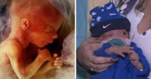 Tiny Survivor: 610g Premature Baby Defies Odds