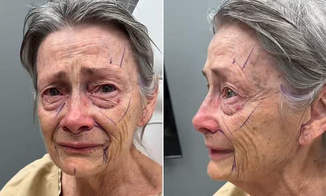 70-Year-Old Stuns With 30-Year Facelift Transformation