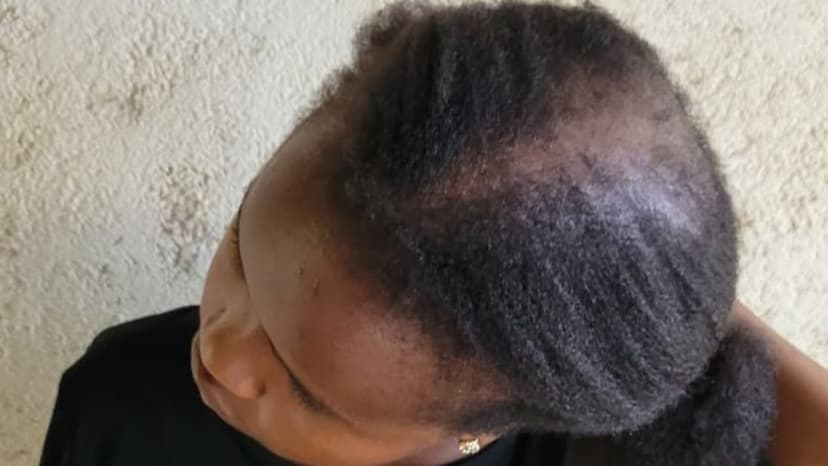 Alopecia Awareness: African Women Speak Out