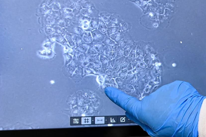 AI Spots Pancreatic Cancer Years Early