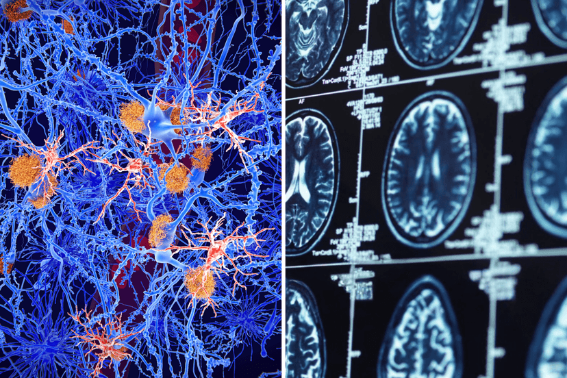 Alzheimer's Spread Secret Unlocked by Brain Protein