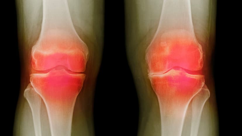 Joints Reborn: New Hope for Arthritis Sufferers