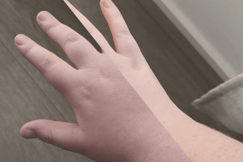 Artist's Hands Crushed by Rare Diagnosis