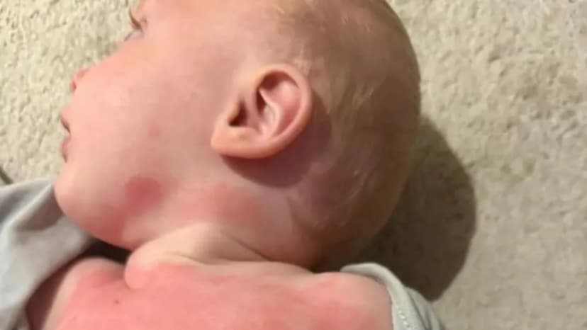 Plane chat soothes baby's eczema in days