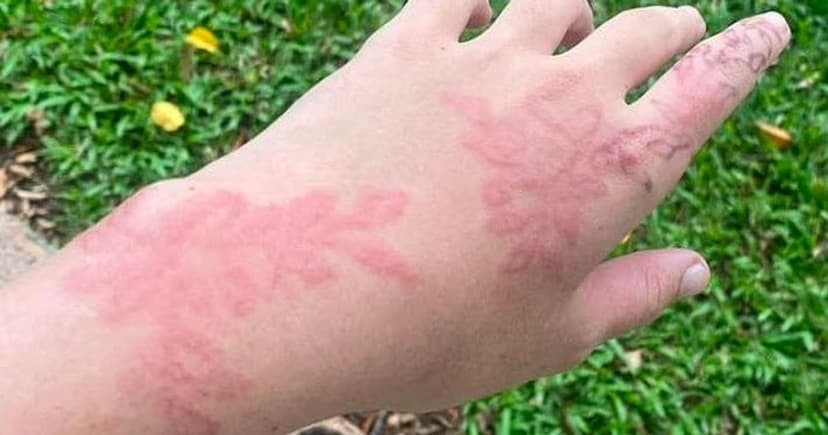 Black Henna Scars: Bali Holiday Nightmare