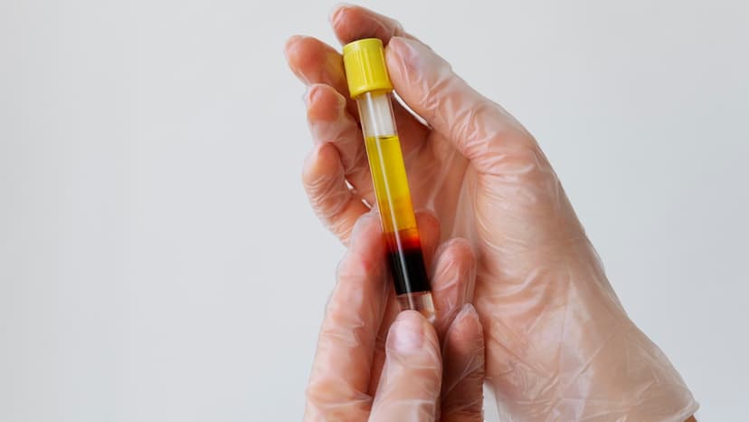 Ministry Eyes End to Redundant Blood Product Tests