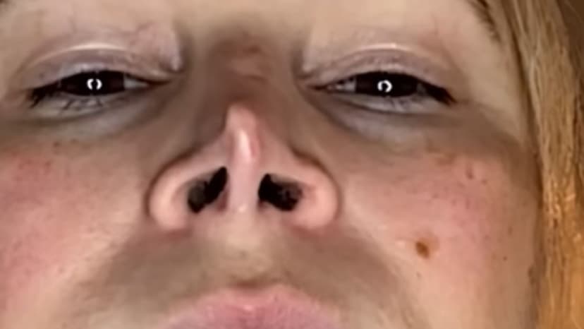 Grinch-like Nose Fixed: Texas Woman's Botched Surgery Nightmare