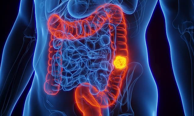Immunotherapy Breakthrough: Bowel Cancer Patients Remain Cancer-Free