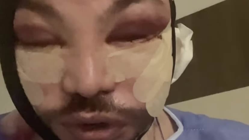 Brotox Boom: Men Embrace Cosmetic 'Tweakments'