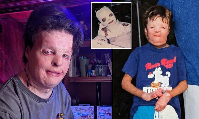 Burn Survivor Becomes Firefighter to Conquer Trauma