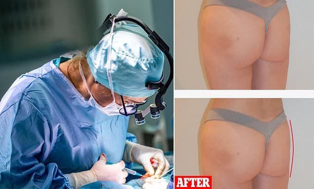 'Weird' Procedure Transforms Lives With Cadaver Fat