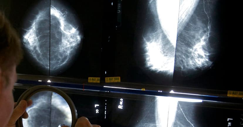 Canadians Demand National Breast Cancer Care Standard