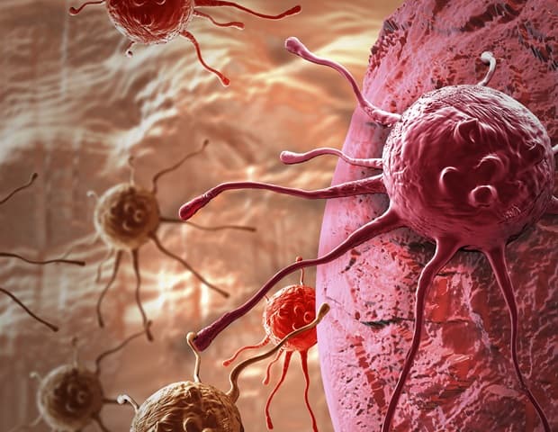 Cancer Diagnosis? Stroke Risk Soars