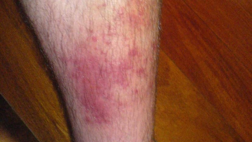 Cellulitis: The Hidden Skin Threat You Can't Ignore