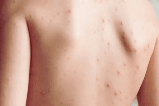 Chennai Sees Over 800 Chickenpox Cases