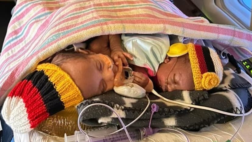 One Twin Survives Grueling Separation in Sydney