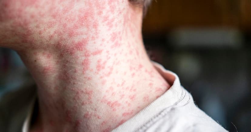 Connecticut Sees First Measles Case Since 2021
