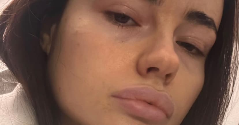 Young Woman Warns of Cosmetic Procedure Addiction