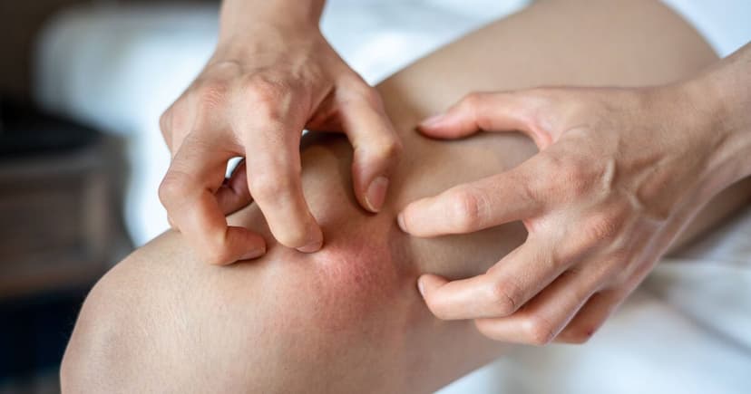 NHS Warns: Telltale Leg Symptom May Signal Crohn's