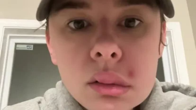 Dangerous 'Death Triangle' Pimple Squeeze Lands Woman in Hospital