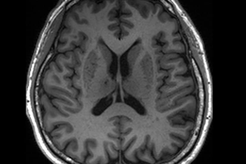 Brain Drains Clogged? New MRI Scan Key to Early Alzheimer's Detection